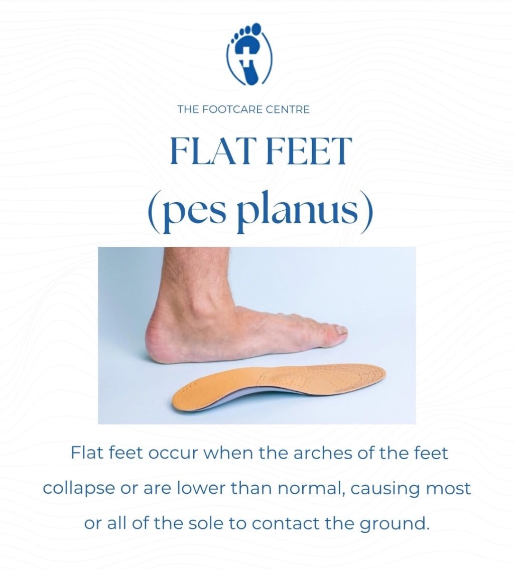 Flat Feet